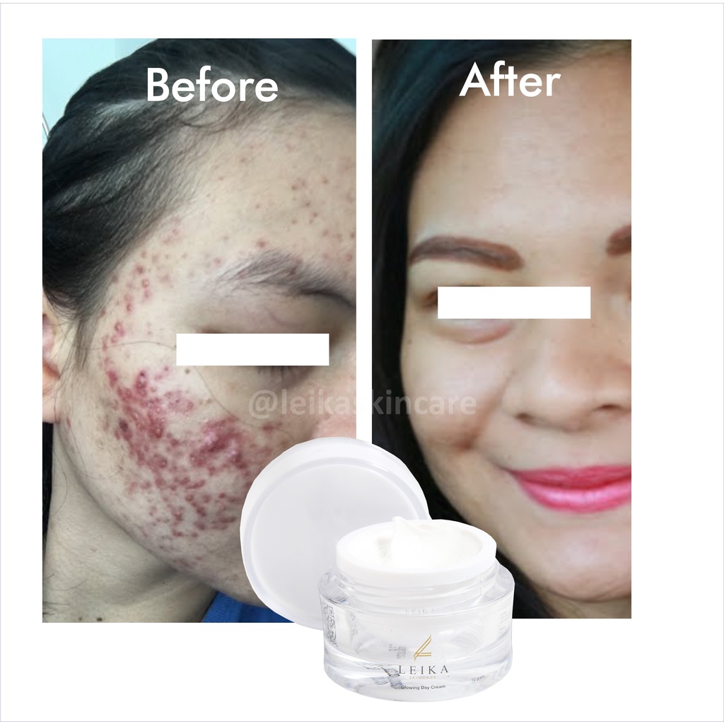 Cream Penghilang Jerawat Ampuh Sudah BPOM! Cream Penghilang Jerawat Membandel Krim Penghilang Jerawat Penghilang Bekas Jerawat Obat Jerawat &amp; Bekas Jerawat Cream Penghilang Bekas Jerawat Glowing Day Cream Leika Skincare 10gr Halal MUI Resmi BPOM