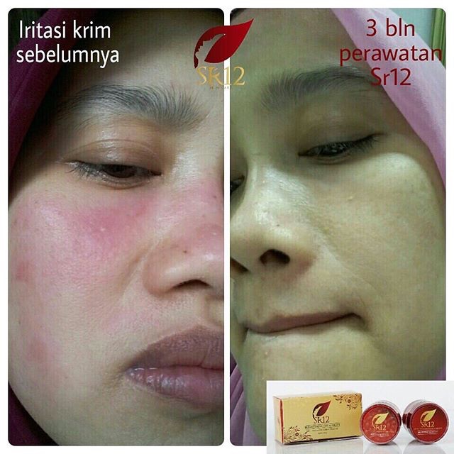 SR12 HERBAL SKINCARE BRIGHTENING DAY &amp; NIGHT CREAM / KRIM SPF PENCERAH BPOM AMAN / MENYAMARKAN NODA HITAM