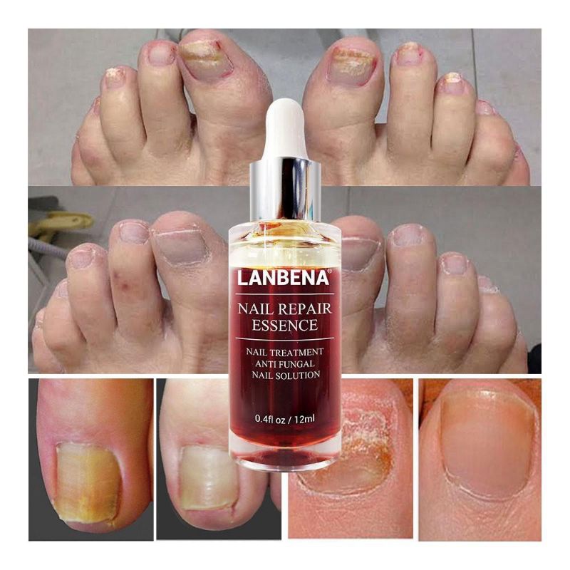 LANBENA Nail Repair Serum Jamur Perawatan Kuku Perawatan Tubuh 12ml BPOM