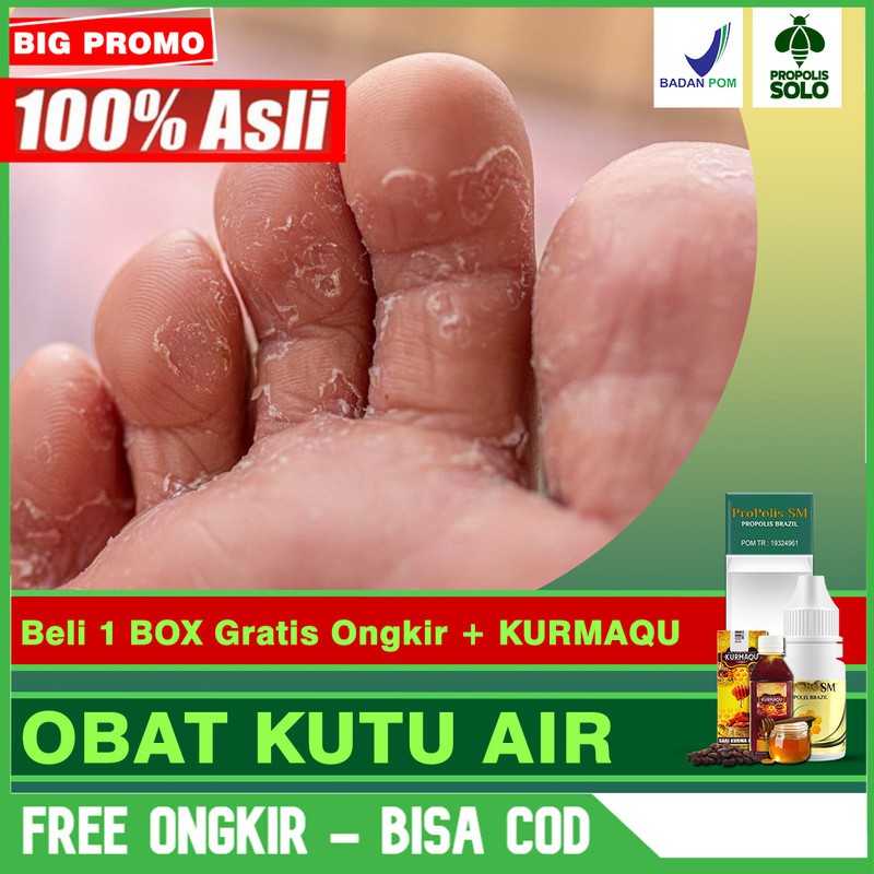 Obat Herbal Kutu Air, Oles, Di Kaki, Tangan, Parah Bernanah Propolis SM Brazil Bisa COD di SOLO