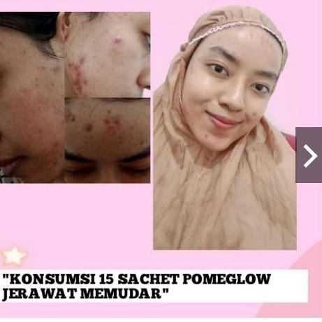 

DS2D✻ MINUMAN KOLAGEN PEMUTIH BADAN VIRAL PERMANEN BPOM AMAN AMPUH MENGHILANGKAN JERAWAT DAN MENCERA