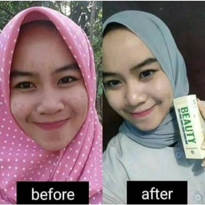 NATURA BEAUTY SPRAY ORIGINAL / SERUM OBAT JERAWAT BATU PRIA WANITA / PENGHILANG JERAWAT