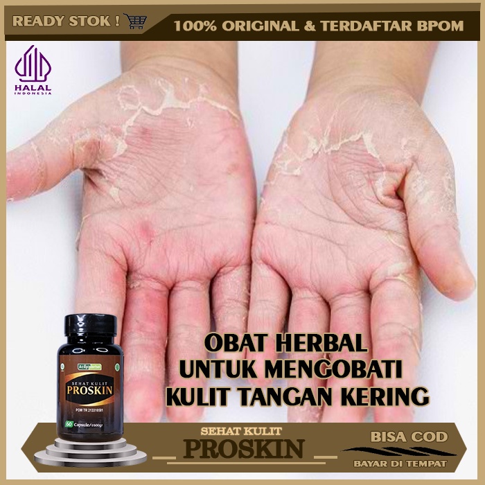 Obat Kulit Tangan Kering, Obat Kulit Jari Tangan Kering, Mengelupas, Pecah Pecah, Obat Tangan Kasar 