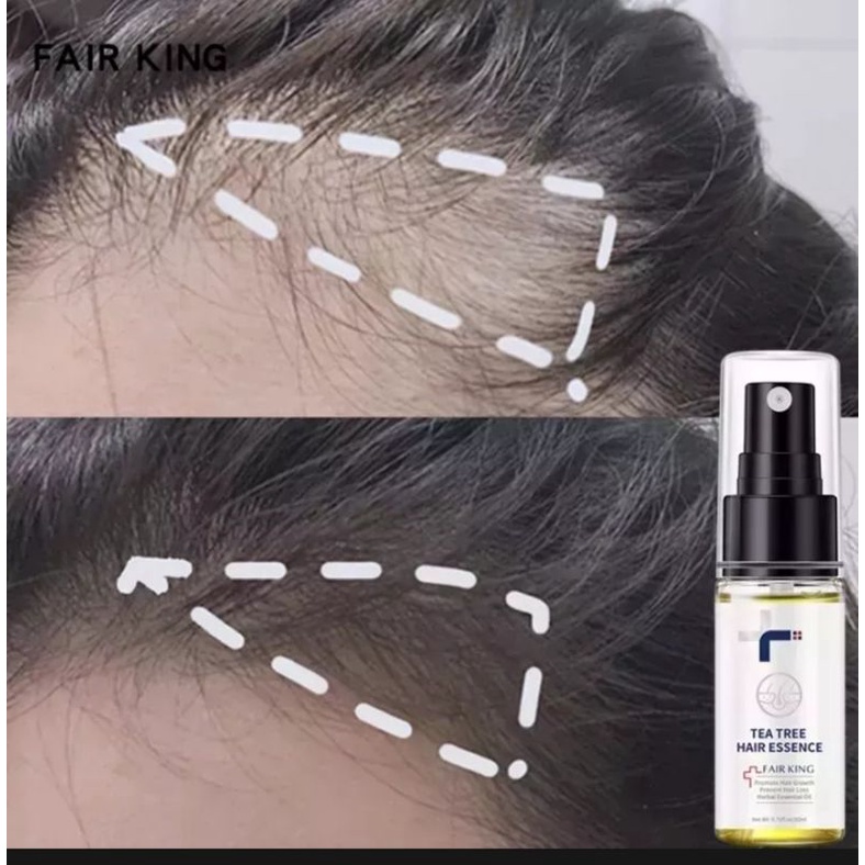 Fair King penumbuh rambut ampuh