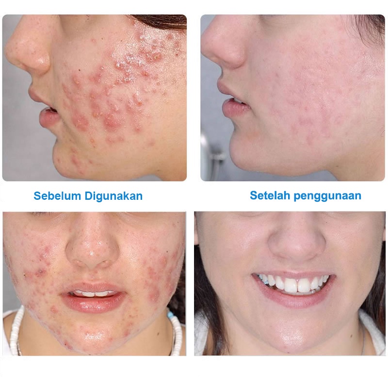 【Barang baru】cream jerawat krim jerawat Lembut dan aman alat jerawat Unisex cream untuk jerawat obat totol jerawat Jerawat Removal ​of Acne Cream Menghilangkan jerawat dengan cepat 30ml