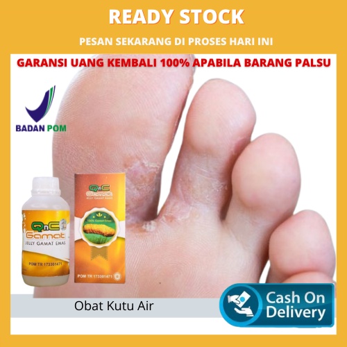 Obat Kutu Air Alami, Kutu Air Basah, Gatal Kutu Air, Gatal Jamur, Kaki Pecah Pecah, Menghilangkan Ga