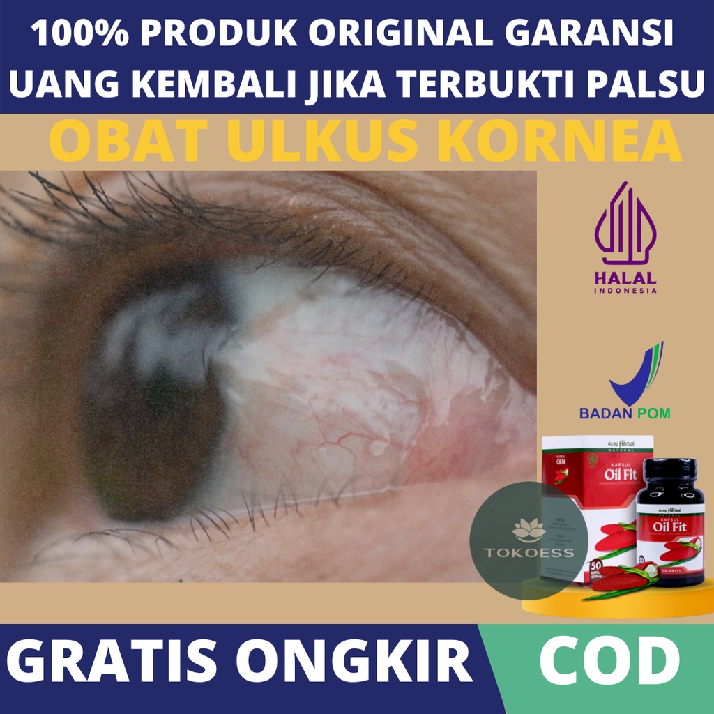 Obat Menghilangkan Titik Putih Di Mata, Obat Infeksi Kornea Mata, Obat Ulkus Kornea Mata, Luka Pada 