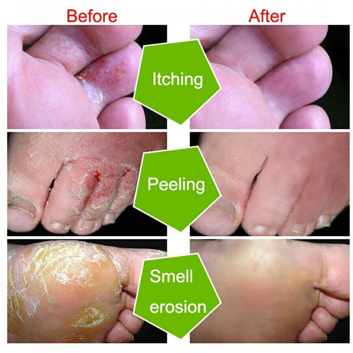 Yiganerjing 100% asli obat gatal dermatitis eksim psoriasis anti jamur bakteri gatel alergi salep-3