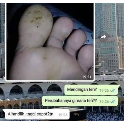 OBAT HERBAL KAKI BERLUBANG, OBAT KAKI RAYAPAN BAU TERLARIS