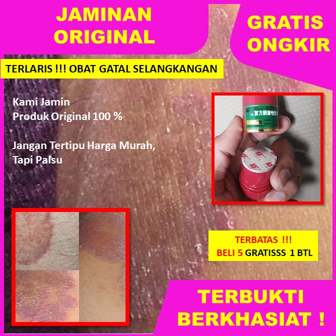 Salep Kulit Gatal Bernanah Salep Gatal Jamur Eksim 100 % ASLI Salep BL