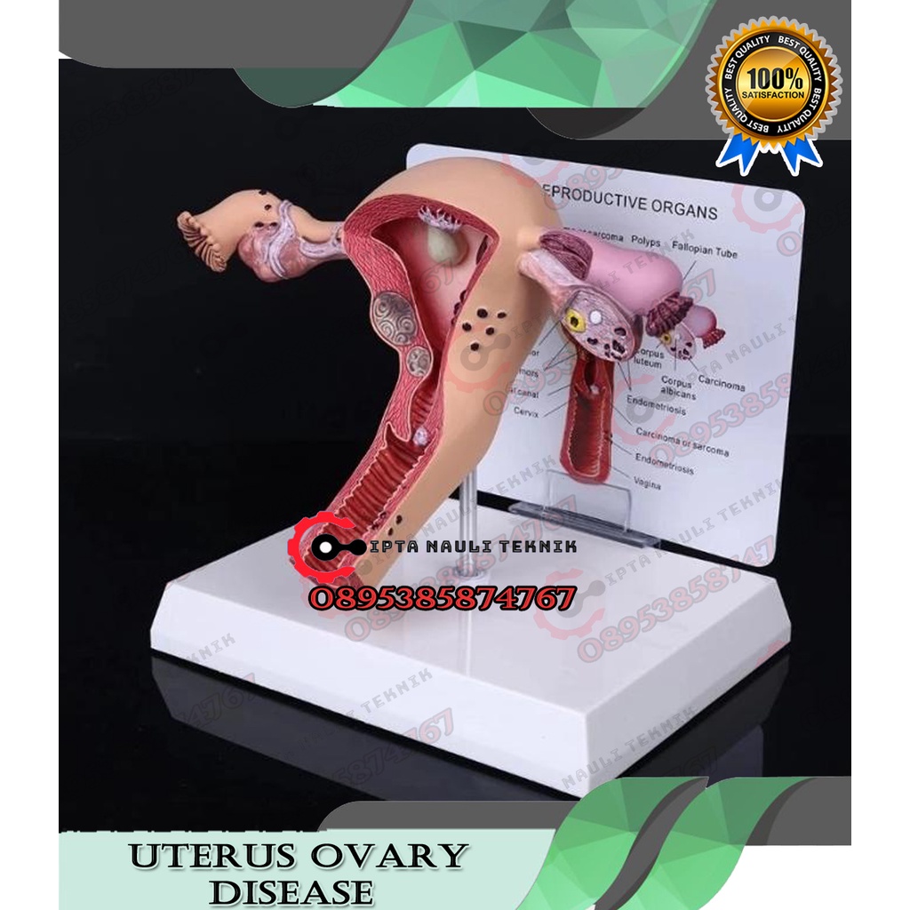 Uterus Ovary Disease - Alat Peraga Anatomi Human Female Uterus