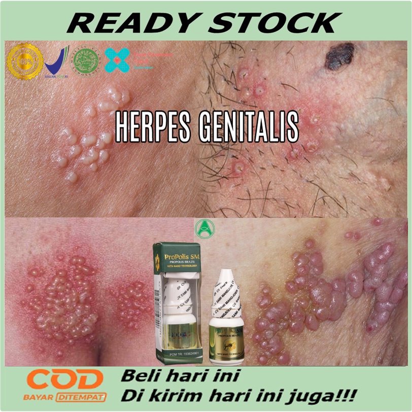 Obat Herpes Genital / Kelamin, Obat herpes, Salep lecet kelamin,  Obat Kutil kelamin, Obat Kutil Kel