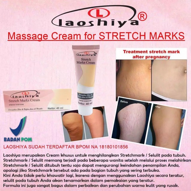 ✿ELYSABETHME✿ Laoshiya cream strech mark penghilang bekas luka guratan garis putih ibu hamil menyusui