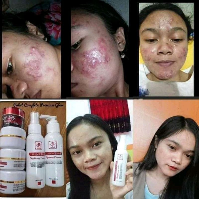 ORIGINAL RK GLOW SKINCARE ACNE/JERAWAT