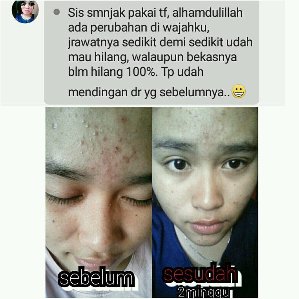 Obat Jerawat TF Miracle Water 100ML TERBUKTI AMPUH &amp; ORI