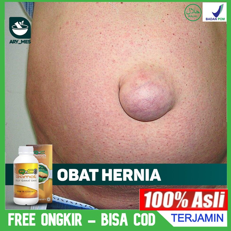 Obat Hernia - Hernia Nukleus - Turun Bero, Berok - Usus Turun Pria Wanita QnC Jelly Gamat 100% ASLI