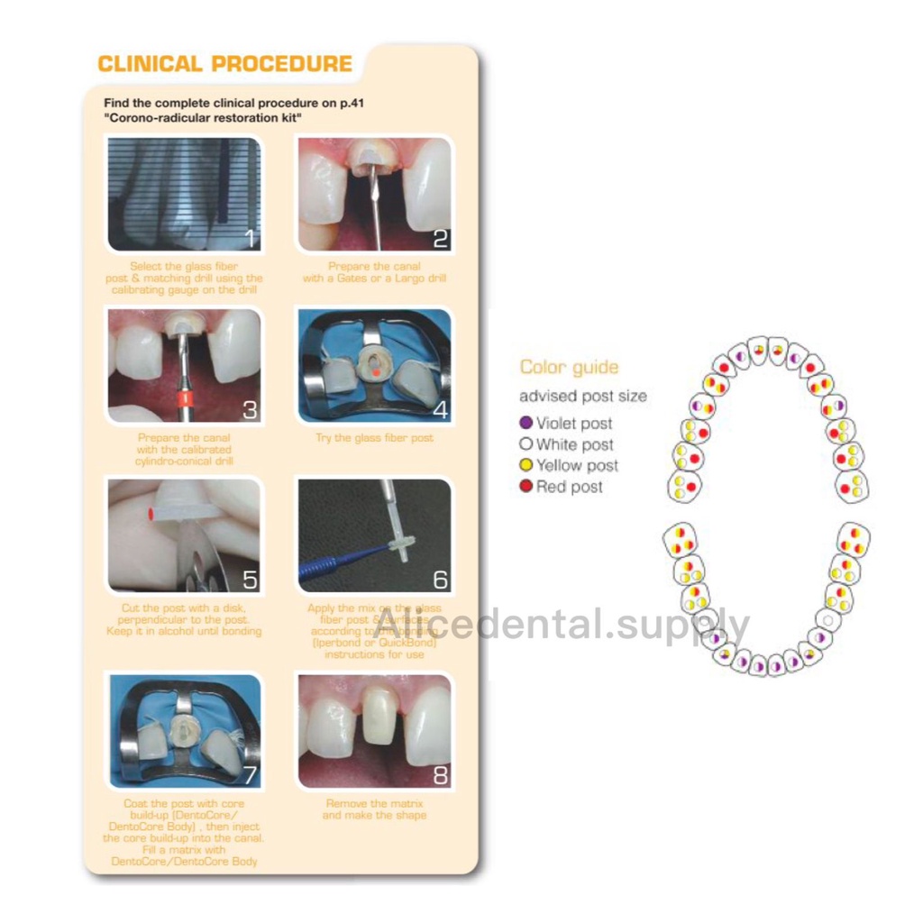 Dental glass fiber post ITENA fiberpost DENTOLIC system pasak gigi tidak bergerigi