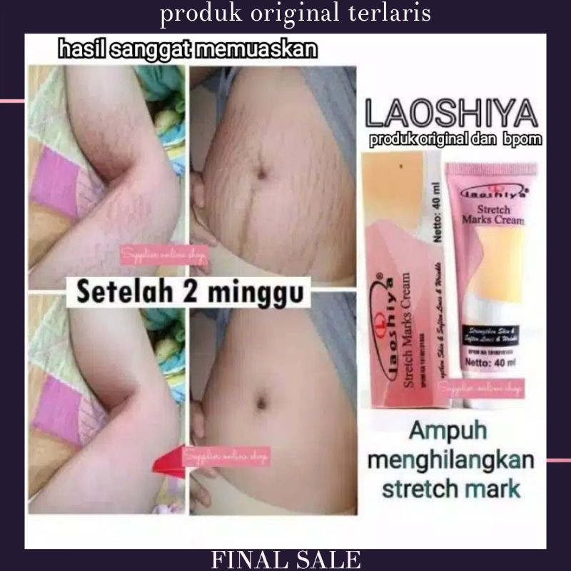 penghilang strechmark ( LAOSHIYA ) salep penghilang bekas luka penghilang keloid penghilang selulit 