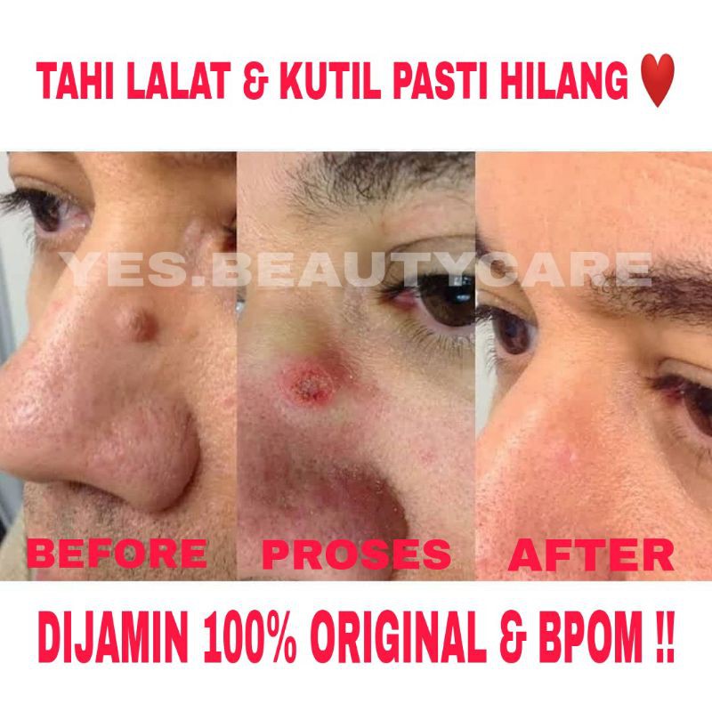 SWISS PARIS LOTION PENGHILANG TAHI LALAT &amp; KUTIL - SPESIALIS_TAILALAT - KRIM TAI LALAT OBAT ORIGINAL