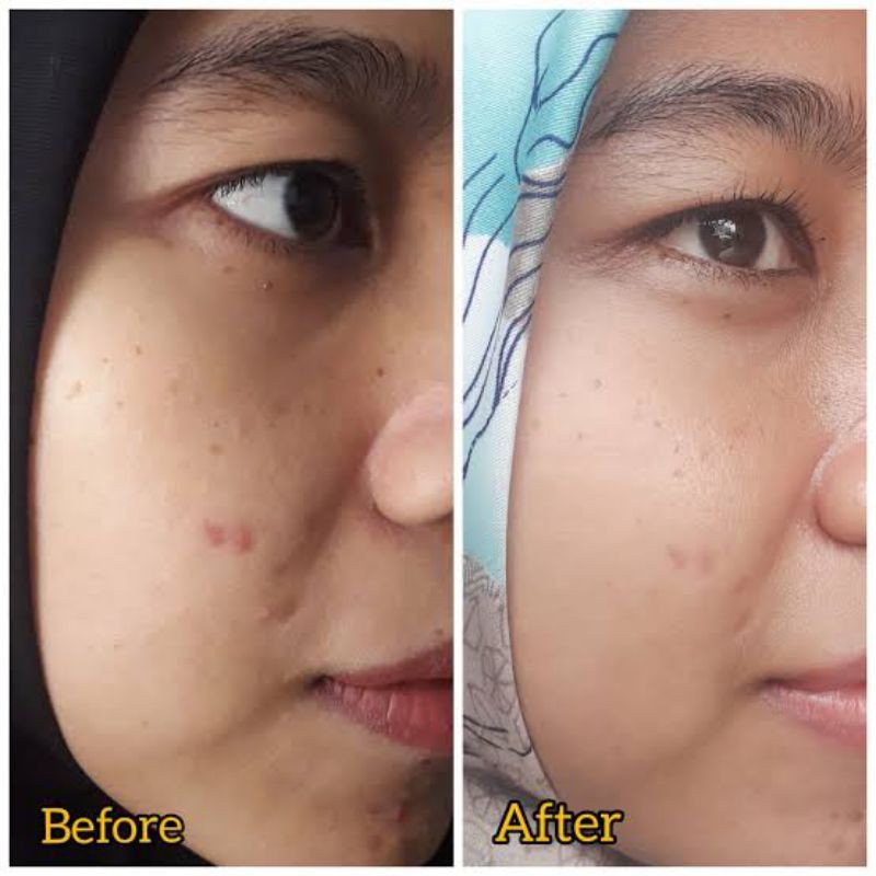 COD - SCARLETT WHITENING CREAM ACNE DAY AND NIGHT - AMPUH BASMI JERAWAT DAN BEKASNYA