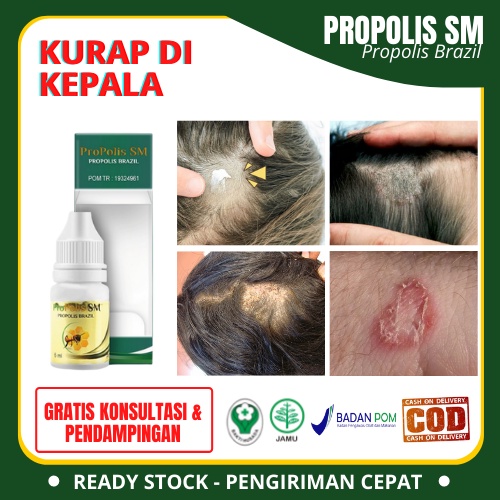 Obat Kepala Pitak, Salep Kulit Kepala Bersisik, Obat Kurap Di Kepala / Tinea Capitis, Penghilang Ber