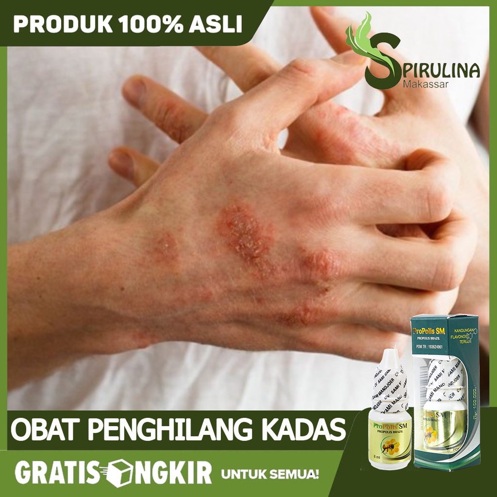 Jual Obat Penghilang Kadas Kurap Panu Gatal Selangkangan Gatal