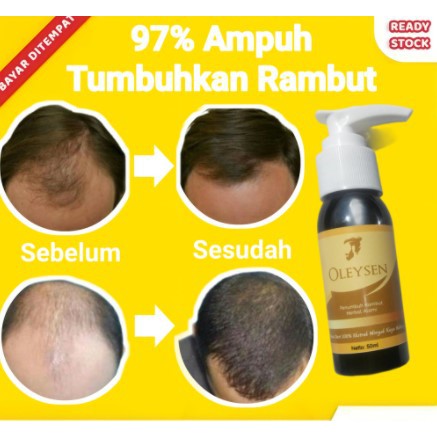 Paling Diminati.. Rambut Botak Cepat Tumbuh Lagi Penumbuh Rambut Alami Penumbuh Rambut Cepat Pria Wa