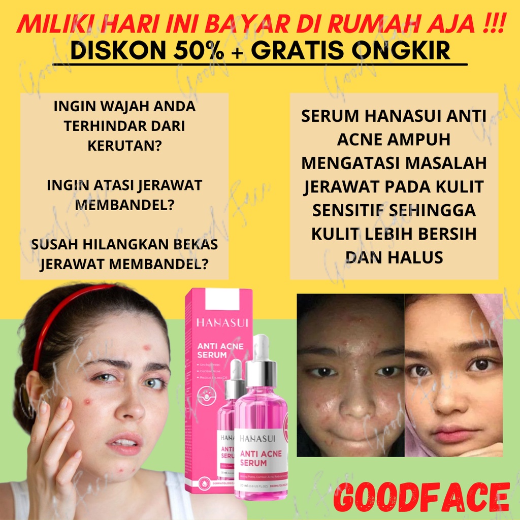 SERUM UNTUK WAJAH BERJERAWAT-Hanasui Serum Anti Acne Original BPOM - Acne Serum Hanasui Jaya Mandiri