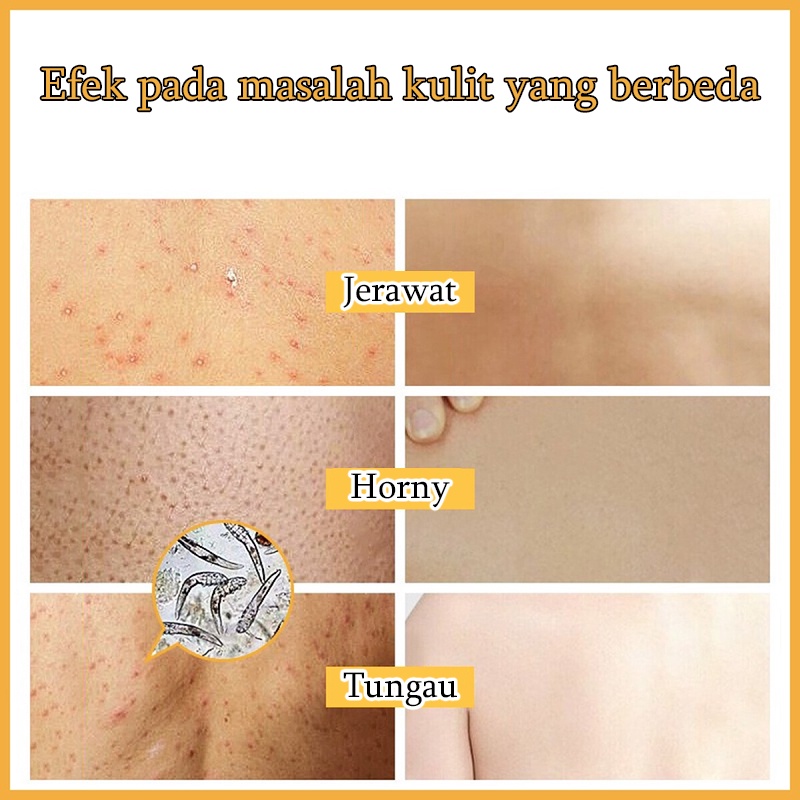 Gel mandi Sabun mandi jerawat cair pemutih badan Acne body wash Whitening body wash Menghilangkan tungau dan jerawat Pemutih kulit Banyak nutrisi Pembersihan lembut Mengangkat kotoran kulit dan sel kulit mati