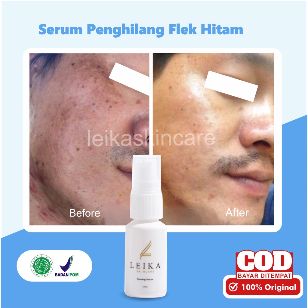Perawatan Pria Serum Penghilang Flek Hitam Permanen Serum Flek Hitam Membandel Serum Wajah Menghilan