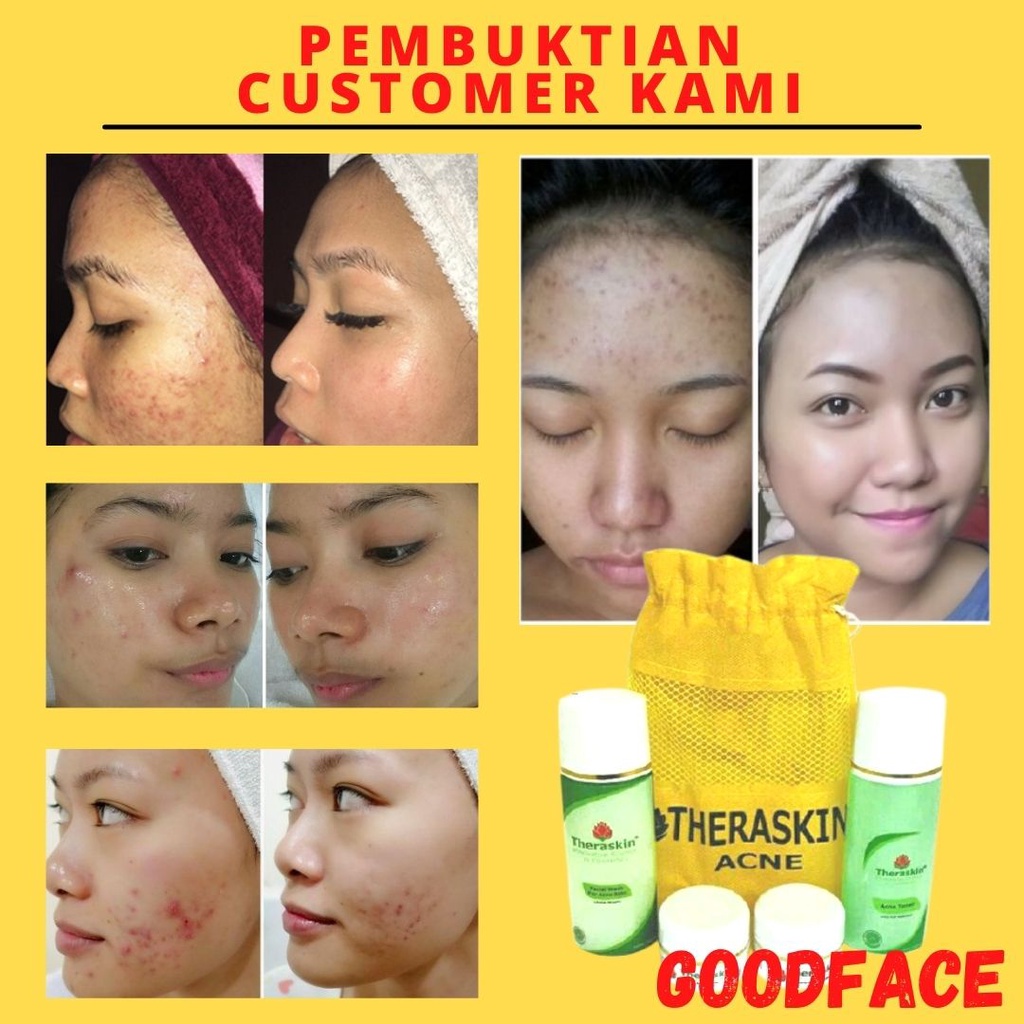 THERASKIN PAKET ACNE ORIGINAL BPOM CREAM PENGHILANG JERAWAT AMPUH PENGHILANG BEKAS JERAWAT