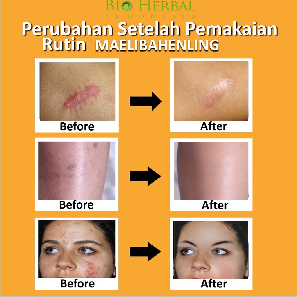 Vicell Meilibahenling Original 100% Obat Krim Penghilang Bekas Luka Hitam Koreng Jerawat Cacar Paling Ampuh