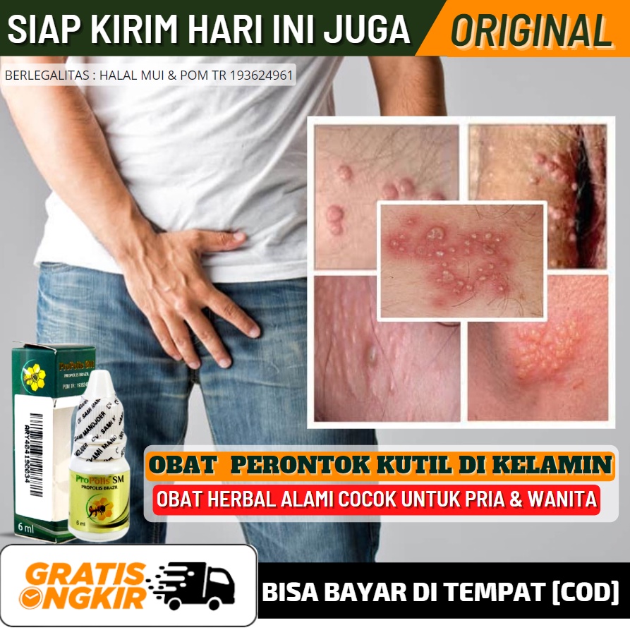 Obat Perontok Kutil Kelamin / Kemaluan Pria & Wanita- Obat Oles 100% Alami Untuk Penghilang Kutil