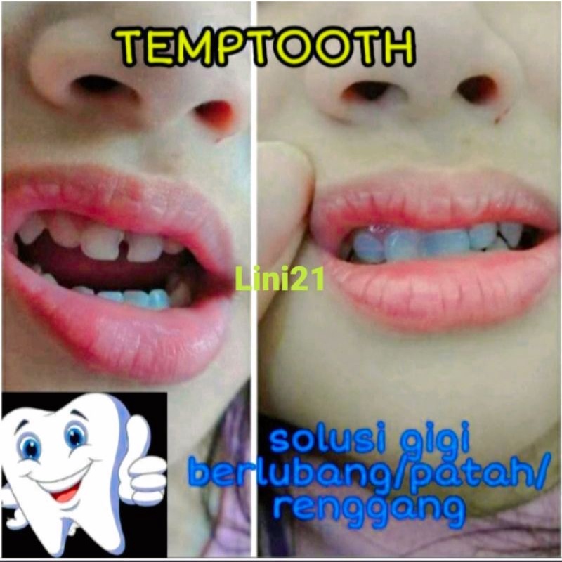 PENAMBAL GIGI-50 BUTIR | TEMPTOOTH | GIGI PALSU BUAT SENDIRI |