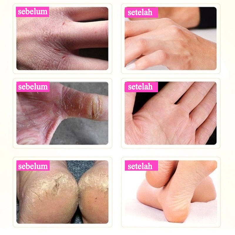 krim kaki 100g obat kaki pecah dan kering krim kaki Exfoliating Kapalan Smoothing Krim Kaki Memperbaiki tumit pecah-pecah dan kering