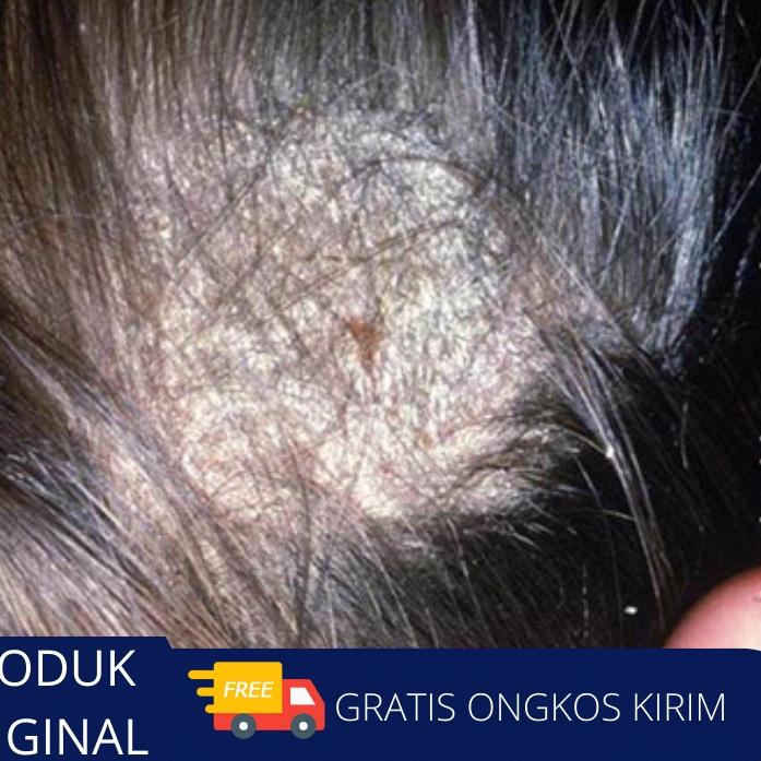 NEW  8.8 Obat Tinea Kapitis Jamur Di Kepala, Obat Jamur Kulit Kepala, Salep Penghilang Jamur kepala,