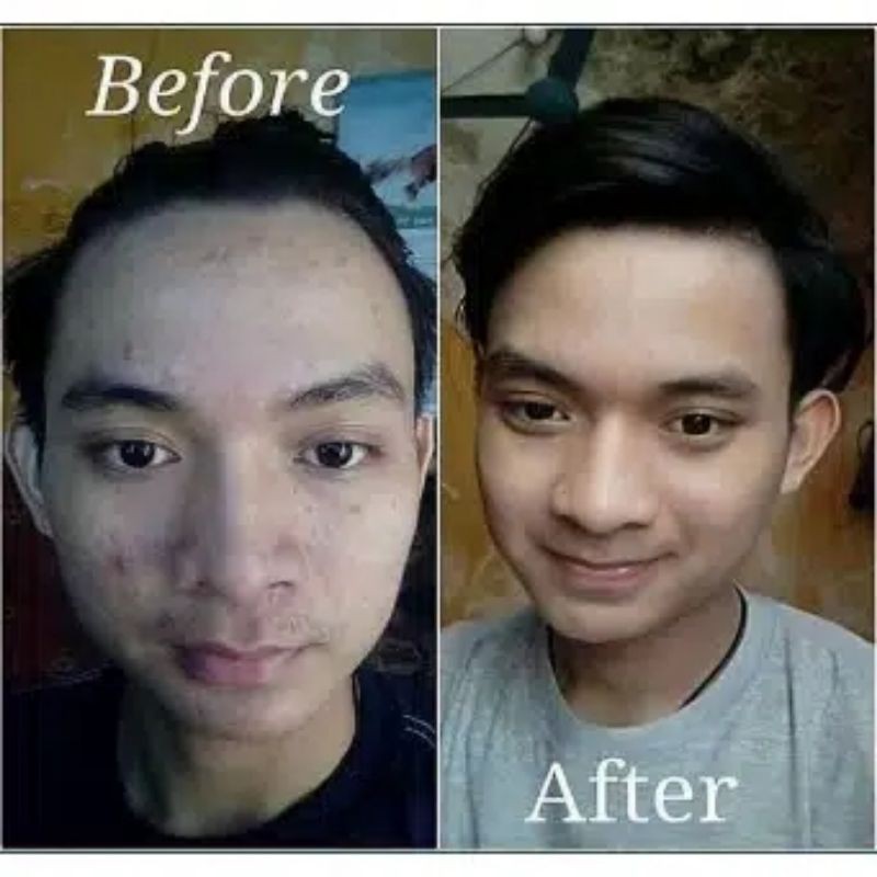 MASKER CHITIN CHITOSAN SOLUSI KULIT BOPENG, BERJERAWAT DAN PENGHILANG FLEK HITAM-7