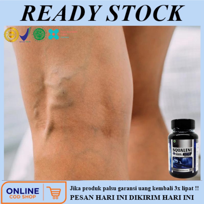 Obat varises, Obat penghilang varises, Obat varises di tangan / ditangan, Obat varises do kaki dan b