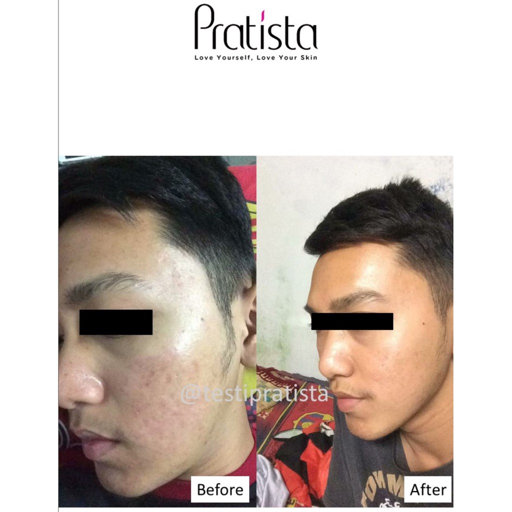 Pratista Centella Enrich Cream Untuk Bopeng Pada Wajah
