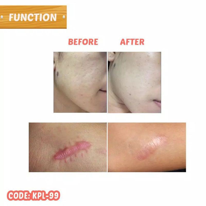 Salep Nutritive Cream Penghilang Bekas Luka Hitam Koreng Jerawat Flek Hitam Keloid BPOM