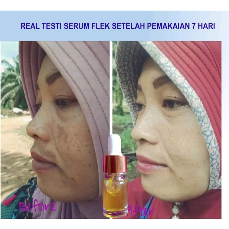 SERUM FLEK MEMBANDEL /SERUM PALING AMPUH/SERUM FLEK MURAH10ML