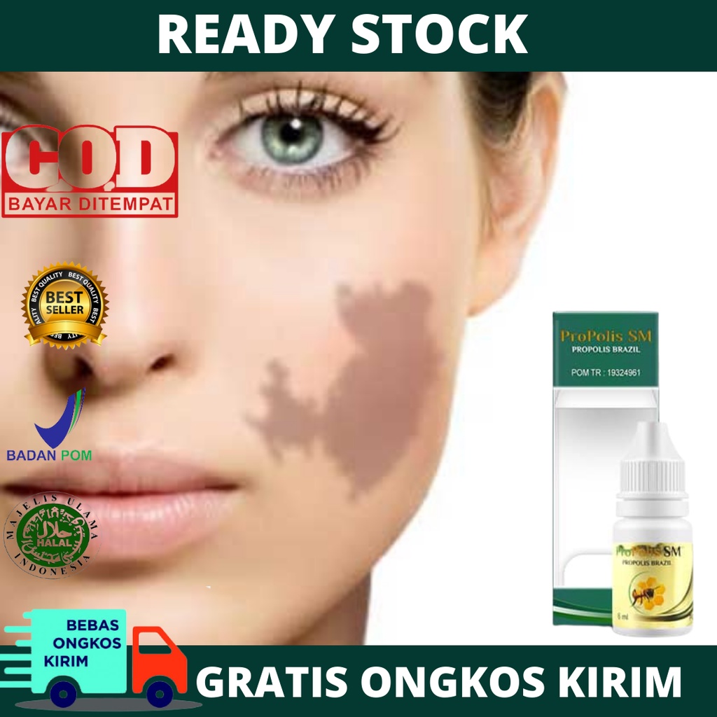 Obat Menghilangkan Tanda Lahir di Wajah, Penghilang Tanda Lahir Coklat, Merah, Hitam, Tanda Lahir Ba