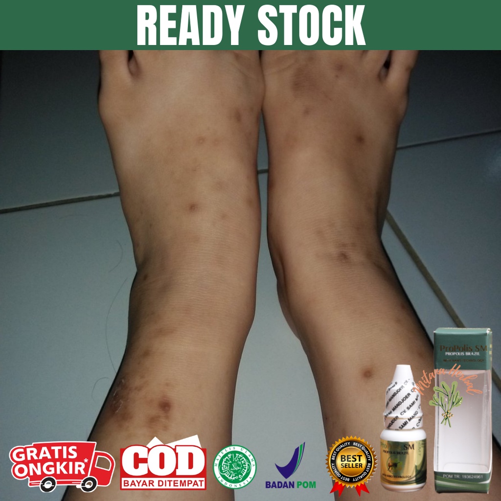 Menghilang bekas luka lama di kaki, penghilang bekas luka, obat penghilang bekas luka koreng hitam, 