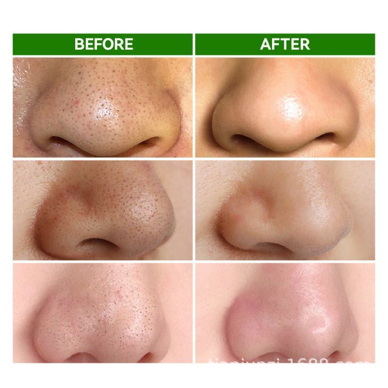 Bundara.id Ko-467 Korean Patent black head removal nursing 100% organic sace lady