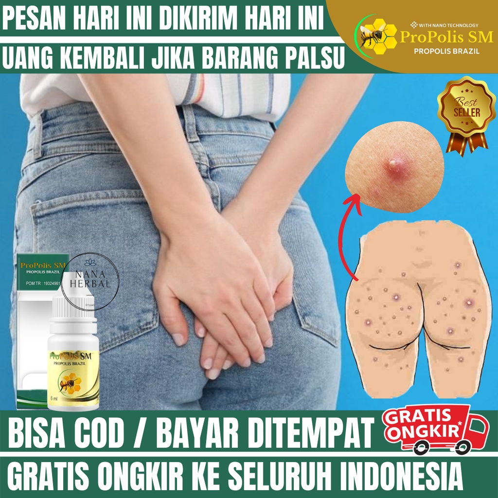 OBAT JERAWAT DI PANTAT, OBAT HILANGKAN FUNGAL ACNE DI PANTAT, JERAWAT AKIBAT INFEKSI JAMUR, OBAT PEN