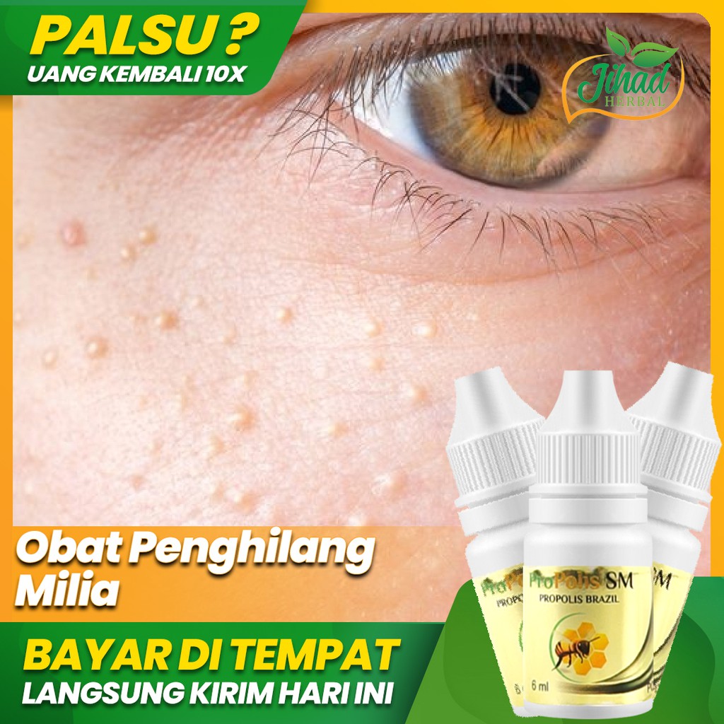 Obat Herbal Untuk Menghilangkan Milia / Penghilang Milia di Wajah Propolis SM Best Seller