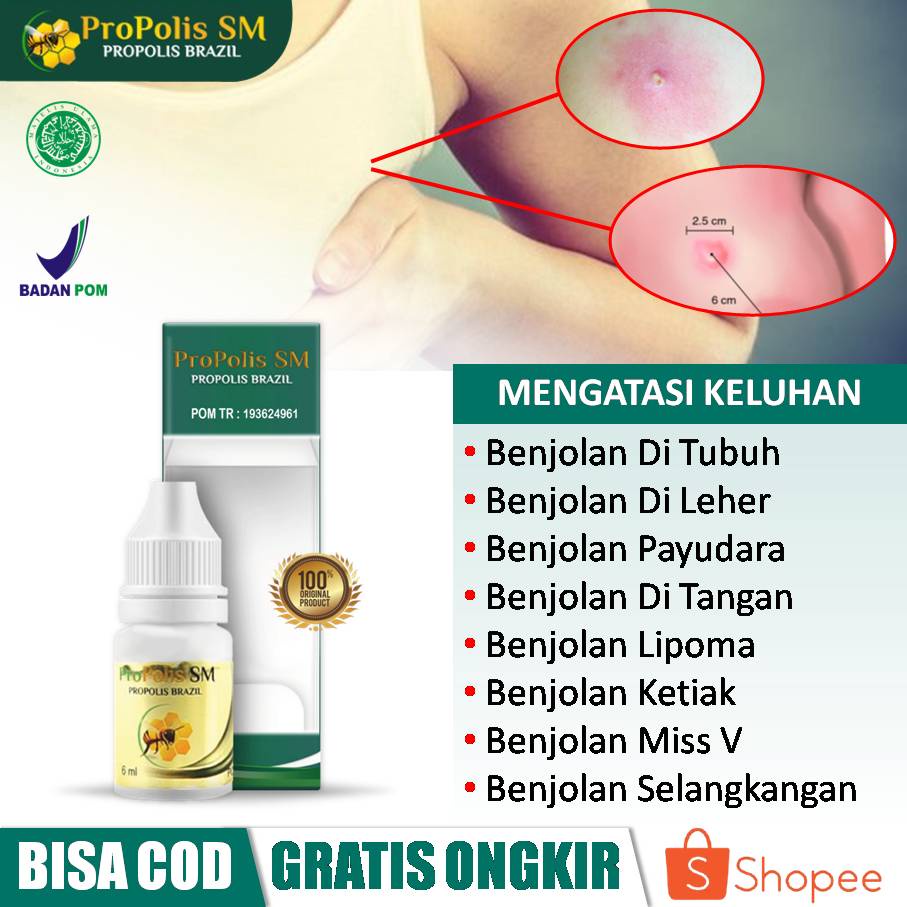 Propolis SM 100% Herbal, Obat Oles Benjolan Di Tubuh, Benjolan Di Leher, Benjolan Payudara, Benjolan