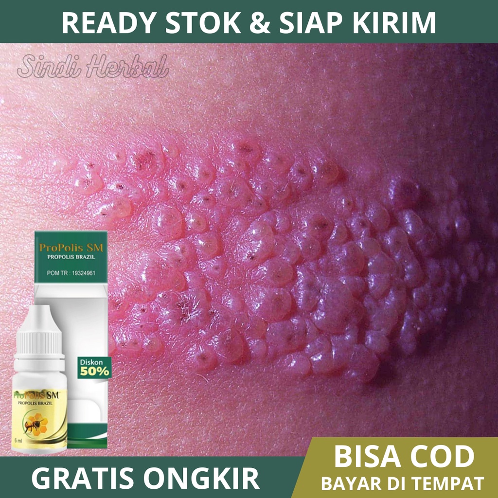 Obat Herpes Kelamin, Obat Gatal Pada Kelamin, Obat Penyakit Kelamin Pria, Obat Penis Gatal, Benjolan