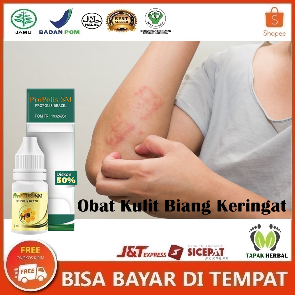 Obat Kulit Biang Keringat Gatal Bintik Berair Ruam Merah Iritasi Bruntusan Gatal Seluruh Badan Binti
