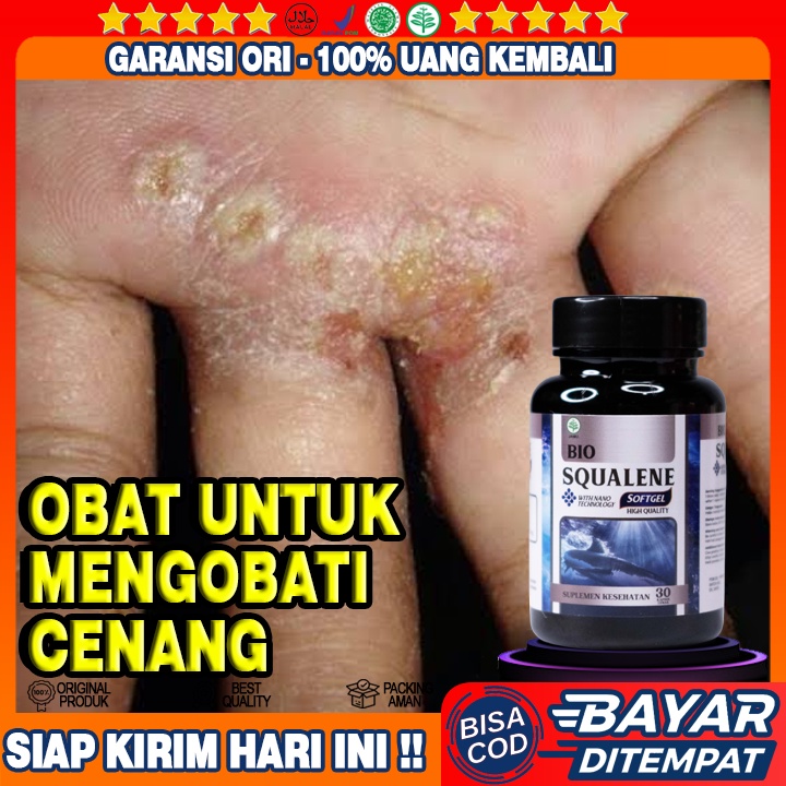 Obat Cenang - Cenang Bernanah - Kulit Cenang Basah Bernanah - Gatal Cenang Bernanah - Cenang Di Tela